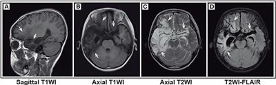 Clinical Characteristics and Prognostic Factors of Children With Anti-N-Methyl-D-Aspartate Receptor Encephalitis